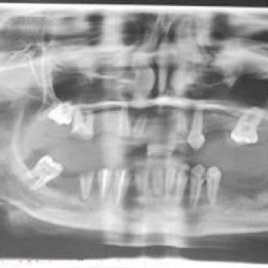 Orthopantomogram: During treatment | Download Scientific Diagram