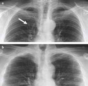 How Do I Analyze a Radiograph of the Chest - Clinical Radiology