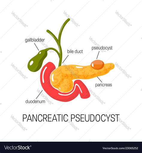 Pancreatic pseudocyst concept Royalty Free Vector Image
