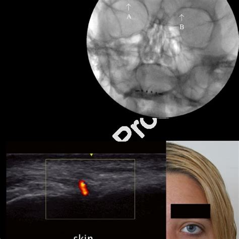 Facial Nerve Ultrasound