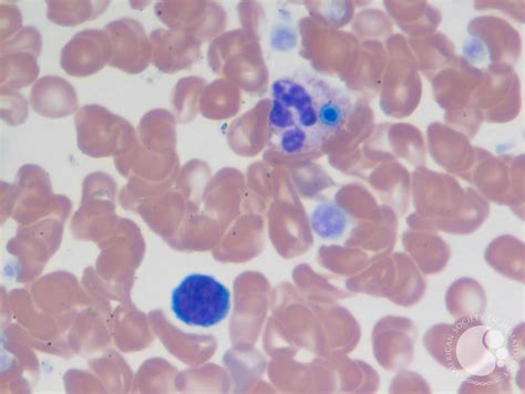 Peripheral blood smear with candida fungemia-1