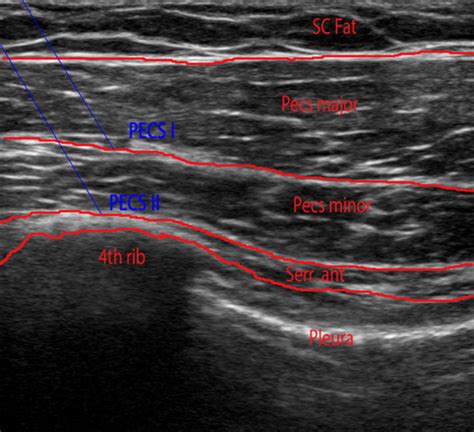 Adenosine or Magnesium Sulphate as Adjuvants for Pectoral Nerves Block in Modified Radical ...