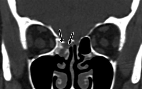 CT of Skull Base Fractures: Classification Systems, Complications, and ...