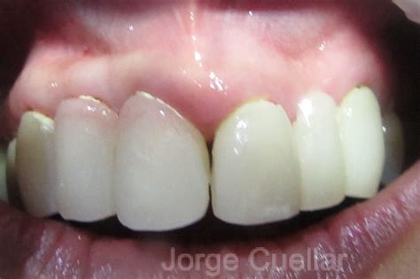 Guided Bone Regeneration and Dental Implants - Jorge Cuellar