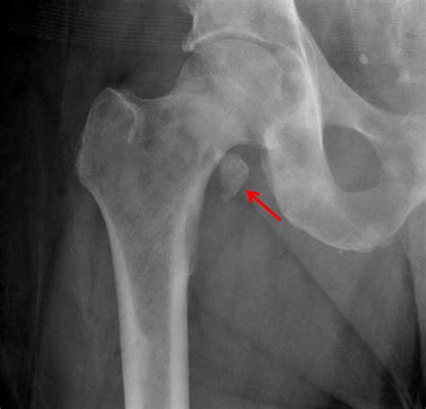 Lesser Trochanter Avulsion Fracture Therapy – FRACTURE