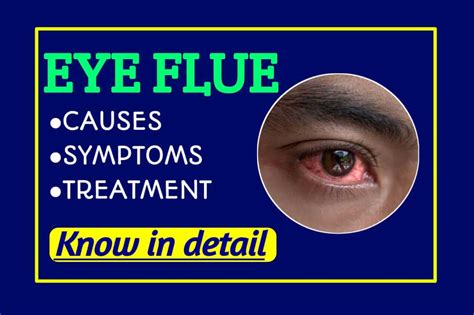 What is Eye Flu - Treatment at Home, Symptoms, Causes