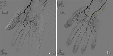 Conventional angiography findings. (a) Occlusion of the ulnar artery... | Download Scientific ...