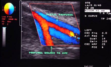 Doppler Color Flow Map | Doppler Color | Flow map, Sonography, Ultrasound