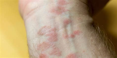 Rash on Arm Causes: Itchy, Red, Treatments, and Remedies - American Celiac