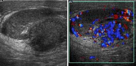 Epididymo-orchitis in a 77 year-old man. (a) Transverse sonography ...