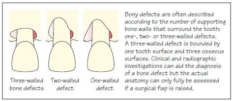 27: Bone Defects and Furcation Lesions | Pocket Dentistry