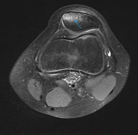 MRI Knee - Paediatic MRI Series - Clinical Cases - GP Referred MRI Scans