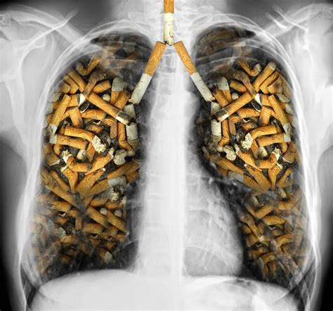 Smoking causes more than 17 cancers | PatientsEngage