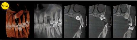 Dental CT Scan | Dental Implant Solutions NW