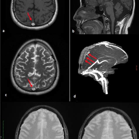 Superior Sagittal Sinus Mri