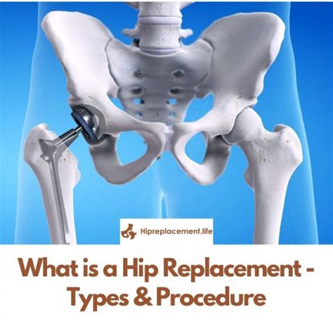 What is a Hip Replacement – Types & Procedure - WriteUpCafe.com