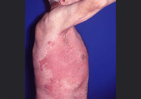 Update on Efficacy of Treatments for Cutaneous Candidiasis - Infectious Disease Advisor