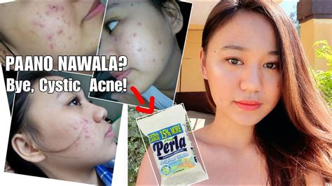 How I Get Rid My Acne | Perla Soap| PHILIPPINES| Tagalog - YouTube