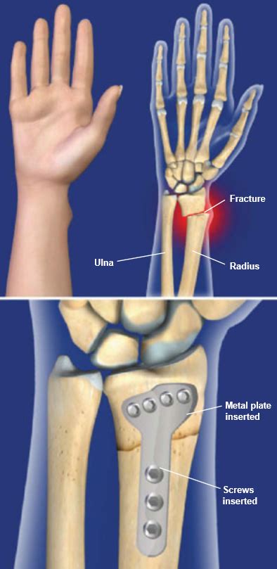 Distal Radius Fracture Repair with Volar Plate | Central Coast Orthopedic Medical Group