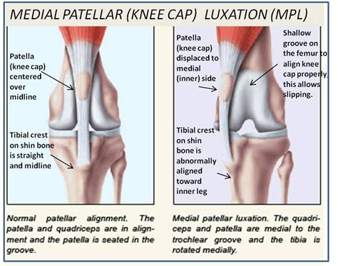 Medial patella luxation (MPL) explanation and anatomical comparison (normal on the left and MPL ...