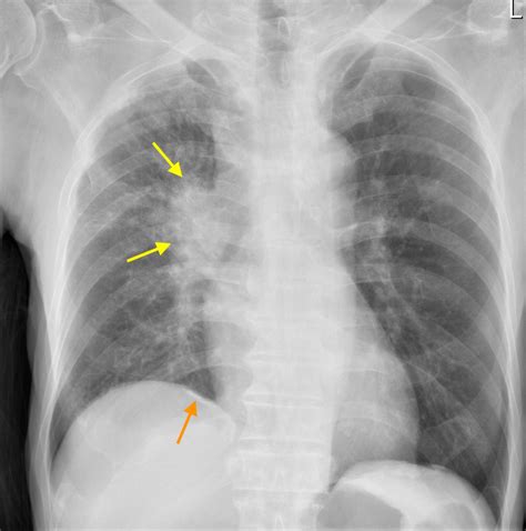 Lung Cancer as related to Asbestos - Pictures