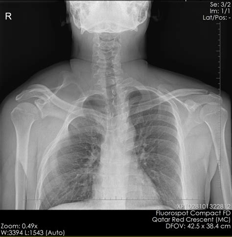 Sprengel Deformity - radRounds Radiology Network