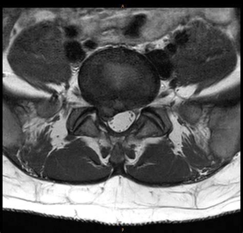 Large L5/ S1 Disc Protrusion Case for Treatment & Management