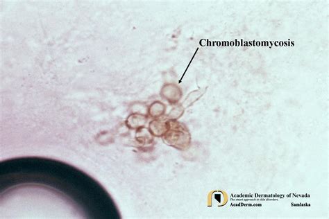 Chromoblastomycosis (CBM): Chromomycosis... - Academic Dermatology of Nevada