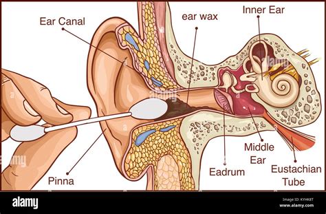 Section of the ear with the earwax - colorful diagram Stock Vector Image & Art - Alamy