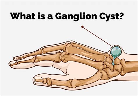 What is a Ganglion Cyst? - Countryside Orthopaedics