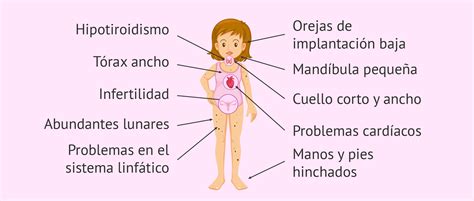 Síndrome de Turner: definición, causas, características y embarazo