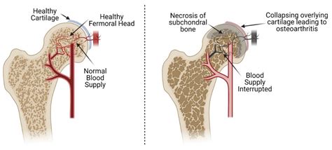 Bioengineering | Free Full-Text | Tissue Engineering Strategies for Treating Avascular Necrosis ...