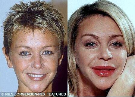 Leslie Ash Plastic Surgery Before And After Photos - CelebLens.Com