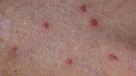 Scabies Vs. Bed Bugs: Identification and Treatment