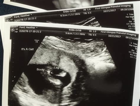 10+ 14 week ultrasound gender pictures ideas