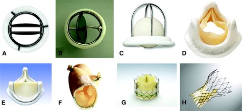 Prosthetic Heart Valves | Circulation