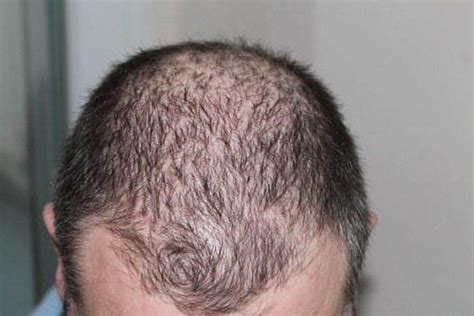 Men Hair Loss Causes And Therapies - Understanding Male Style Baldness And What You Can Do ...