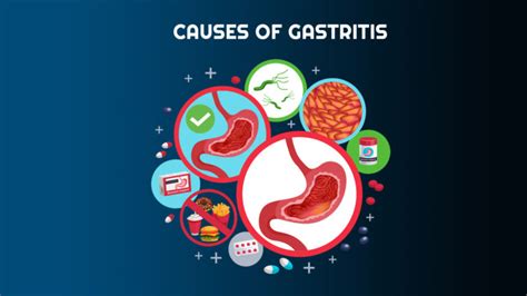 Gastritis-Causes, Treatment And Diagnosis – NutritionFact.in