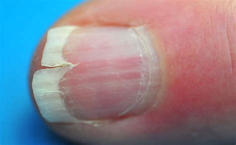 Pin by Levin Dean on split nails | Fingernails, Cracked nails, Split nails