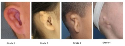 Microtia | Rare Care World