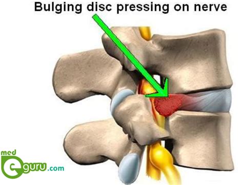 How bulging disc is caused | Treatments for bulging discsMed E Guru