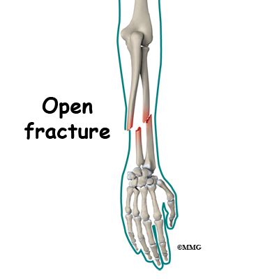 Fractures, Open; Fractures, Compound