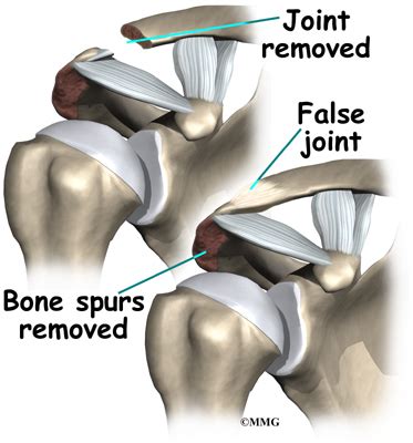 Impingement Syndrome - Orthogate