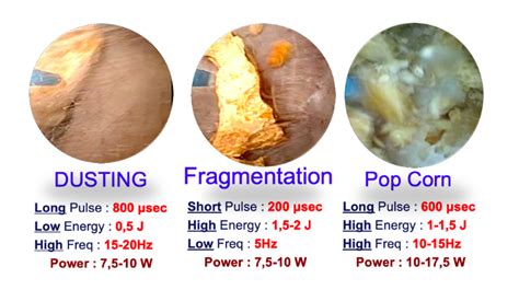 Laser lithotripsy principles - CAU