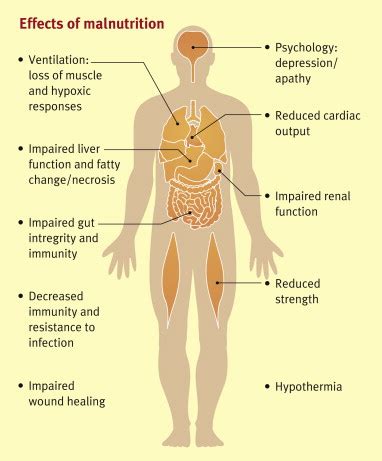 Malnutrition and undernutrition - Medicine