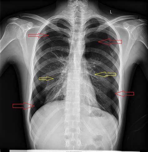 Cureus | Simultaneous Bilateral Spontaneous Pneumothorax: A Rare Complication of Osteosarcoma