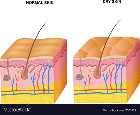 Cartoon of the layers normal skin and dry ski Vector Image