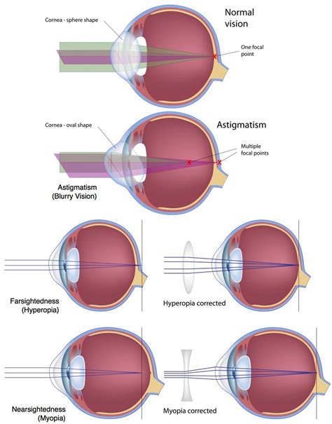 LASIK Eye Surgery for Vision Correction at Fort Worth Eye Associates