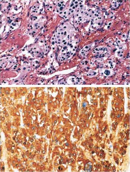 Pathology of Head and Neck Tumors - Oncology - Mitch Medical