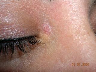 Spot On. Spot Off!: Psoriasis on the Eyelid